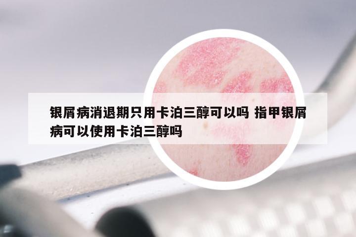 银屑病消退期只用卡泊三醇可以吗 指甲银屑病可以使用卡泊三醇吗