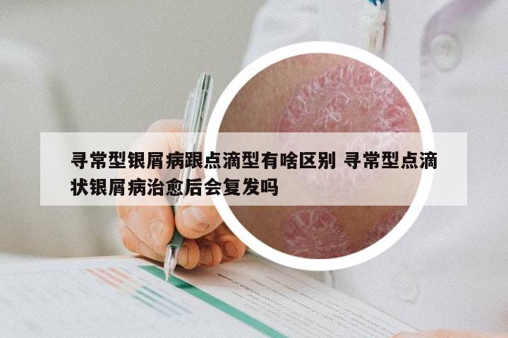 寻常型银屑病跟点滴型有啥区别 寻常型点滴状银屑病治愈后会复发吗