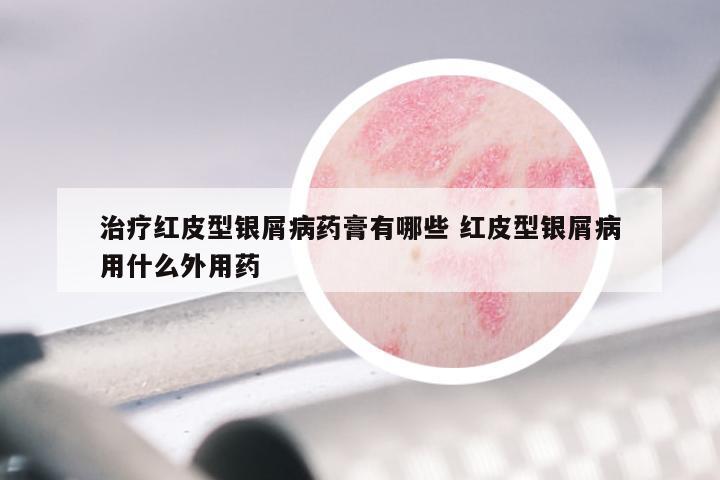 治疗红皮型银屑病药膏有哪些 红皮型银屑病用什么外用药