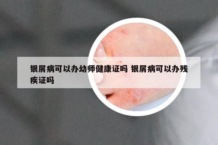 银屑病可以办幼师健康证吗 银屑病可以办残疾证吗