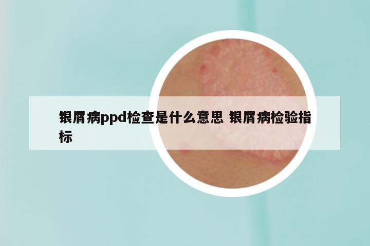 银屑病ppd检查是什么意思 银屑病检验指标