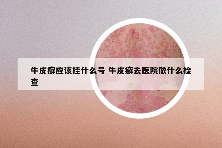 牛皮癣应该挂什么号 牛皮癣去医院做什么检查