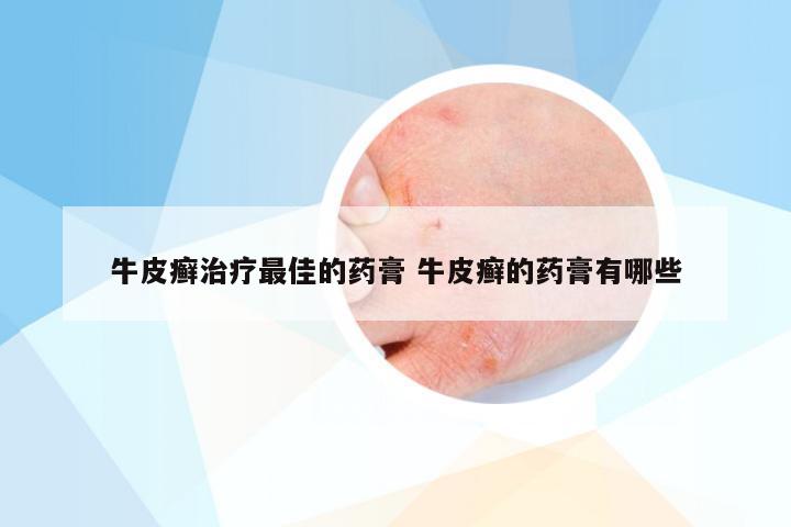 牛皮癣治疗最佳的药膏 牛皮癣的药膏有哪些