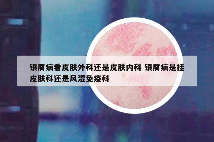 银屑病看皮肤外科还是皮肤内科 银屑病是挂皮肤科还是风湿免疫科