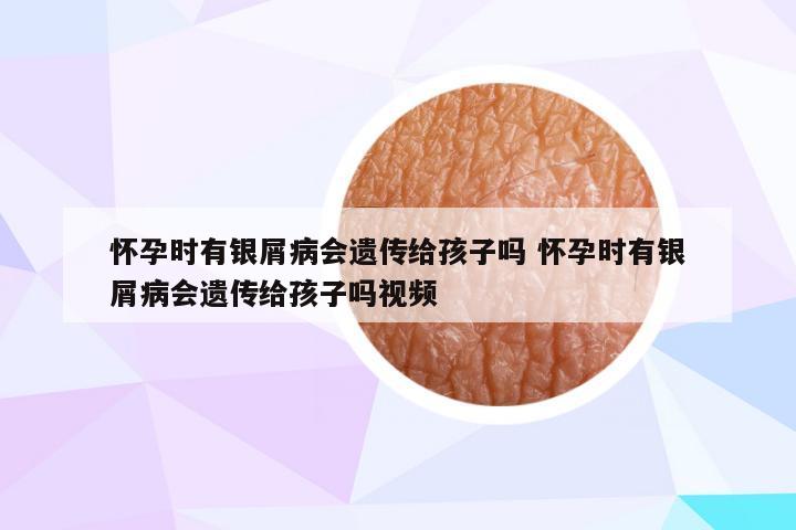 怀孕时有银屑病会遗传给孩子吗 怀孕时有银屑病会遗传给孩子吗视频