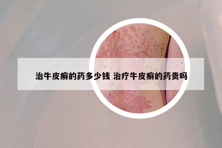 治牛皮癣的药多少钱 治疗牛皮癣的药贵吗