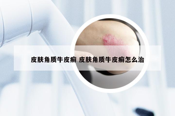 皮肤角质牛皮癣 皮肤角质牛皮癣怎么治