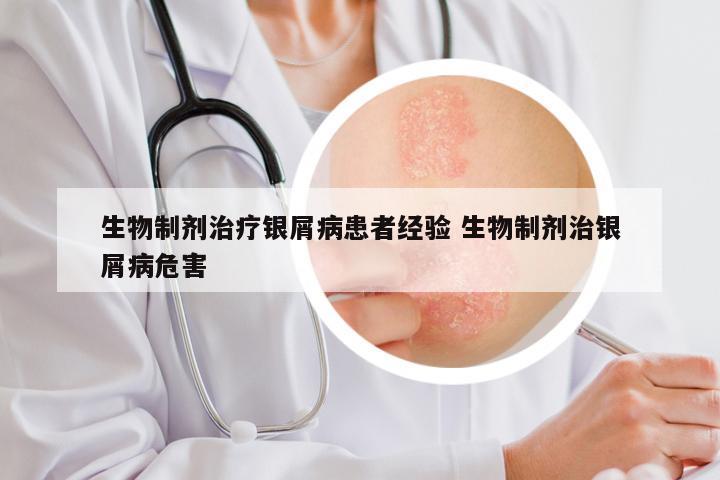 生物制剂治疗银屑病患者经验 生物制剂治银屑病危害