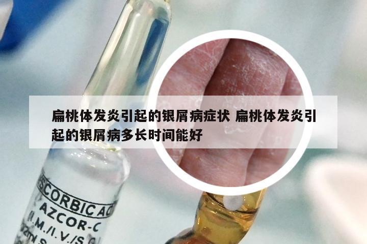 扁桃体发炎引起的银屑病症状 扁桃体发炎引起的银屑病多长时间能好