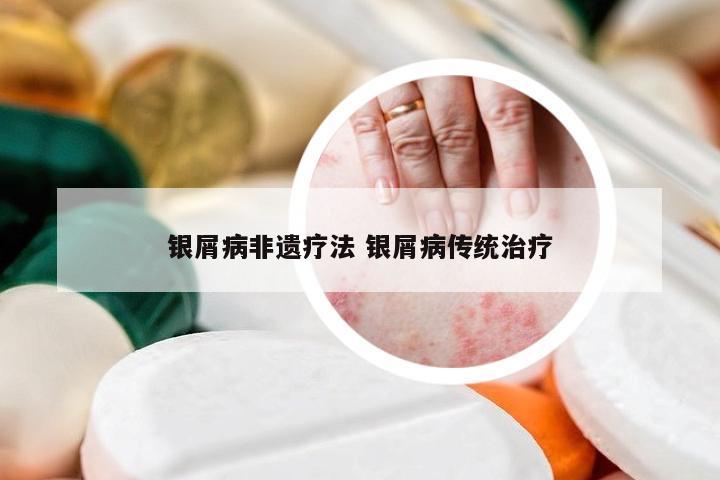 银屑病非遗疗法 银屑病传统治疗