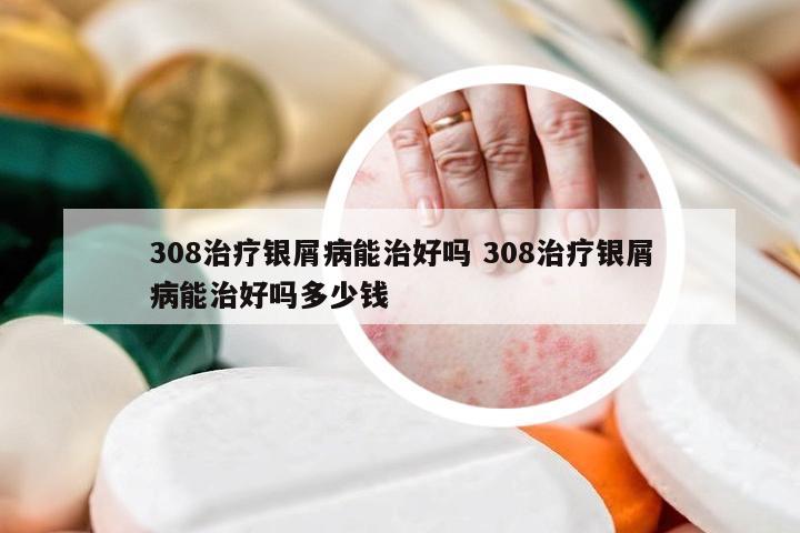 308治疗银屑病能治好吗 308治疗银屑病能治好吗多少钱
