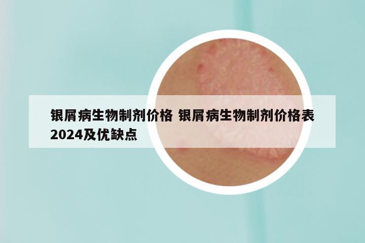 银屑病生物制剂价格 银屑病生物制剂价格表2024及优缺点