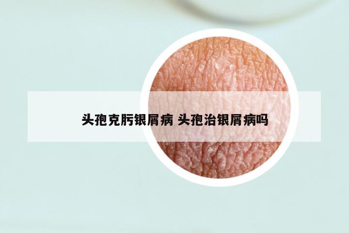 头孢克肟银屑病 头孢治银屑病吗