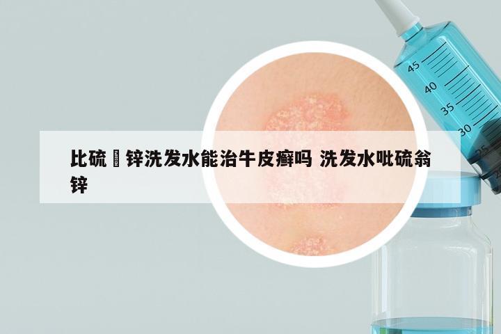 比硫鎓锌洗发水能治牛皮癣吗 洗发水吡硫翁锌