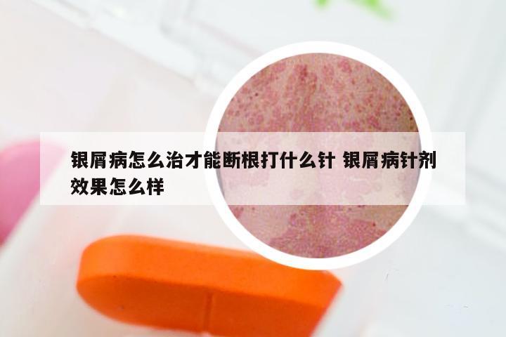 银屑病怎么治才能断根打什么针 银屑病针剂效果怎么样