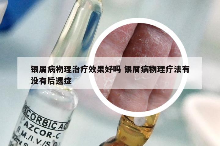 银屑病物理治疗效果好吗 银屑病物理疗法有没有后遗症