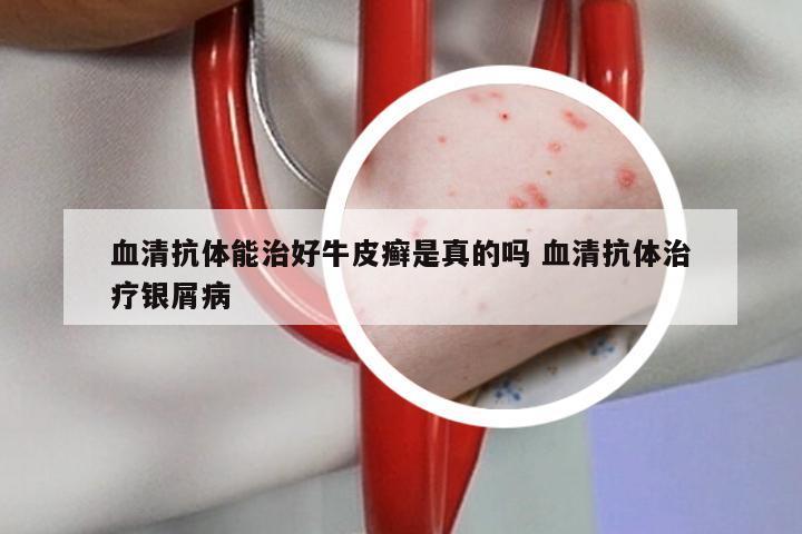 血清抗体能治好牛皮癣是真的吗 血清抗体治疗银屑病