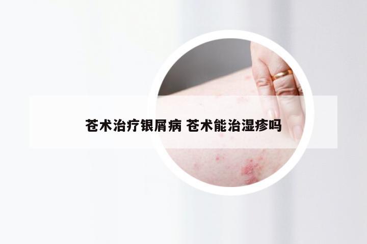苍术治疗银屑病 苍术能治湿疹吗