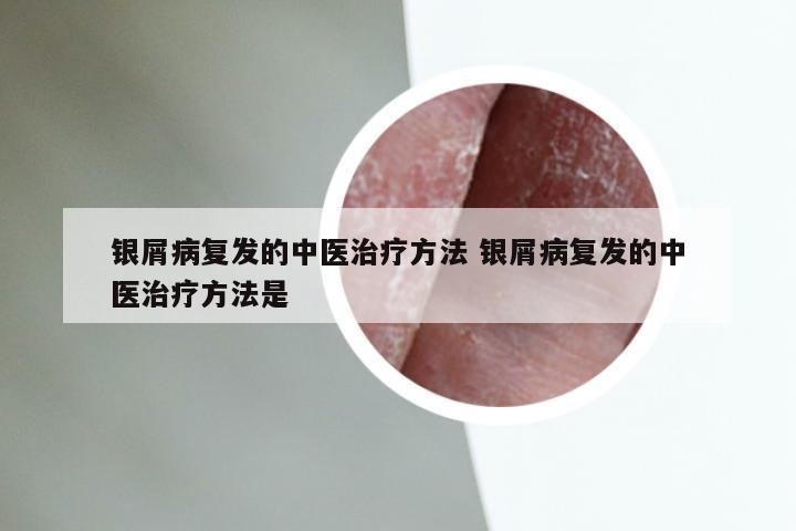 银屑病复发的中医治疗方法 银屑病复发的中医治疗方法是