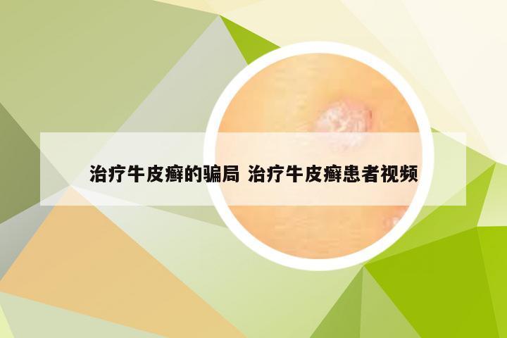 治疗牛皮癣的骗局 治疗牛皮癣患者视频