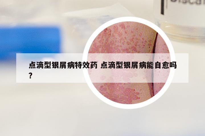 点滴型银屑病特效药 点滴型银屑病能自愈吗?