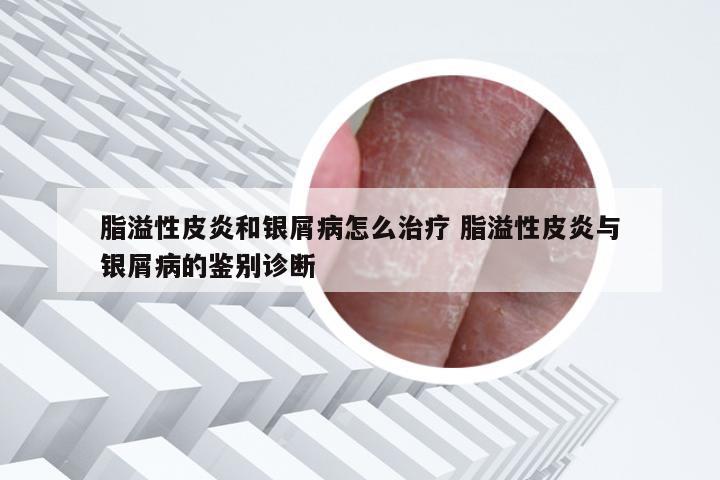 脂溢性皮炎和银屑病怎么治疗 脂溢性皮炎与银屑病的鉴别诊断