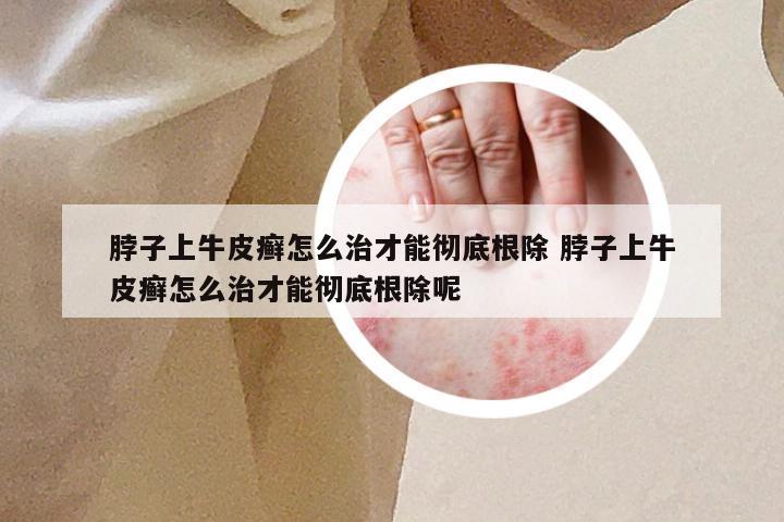 脖子上牛皮癣怎么治才能彻底根除 脖子上牛皮癣怎么治才能彻底根除呢