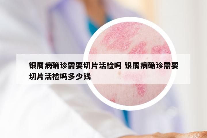 银屑病确诊需要切片活检吗 银屑病确诊需要切片活检吗多少钱