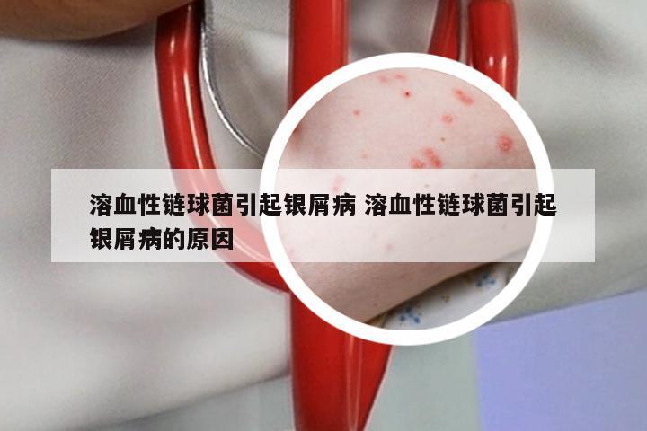 溶血性链球菌引起银屑病 溶血性链球菌引起银屑病的原因