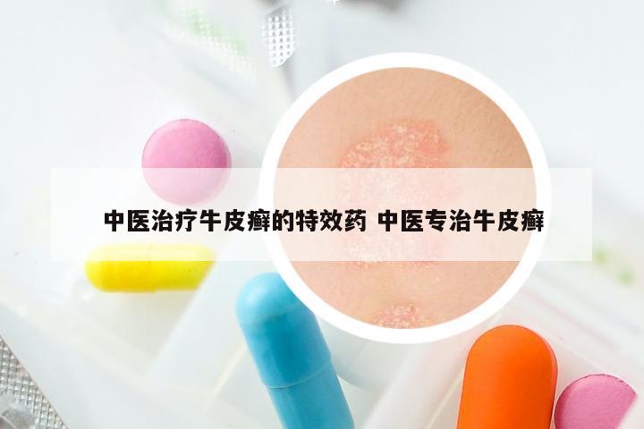 中医治疗牛皮癣的特效药 中医专治牛皮癣