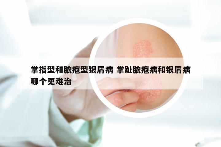 掌指型和脓疱型银屑病 掌趾脓疱病和银屑病哪个更难治