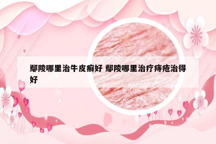 鄢陵哪里治牛皮癣好 鄢陵哪里治疗痔疮治得好