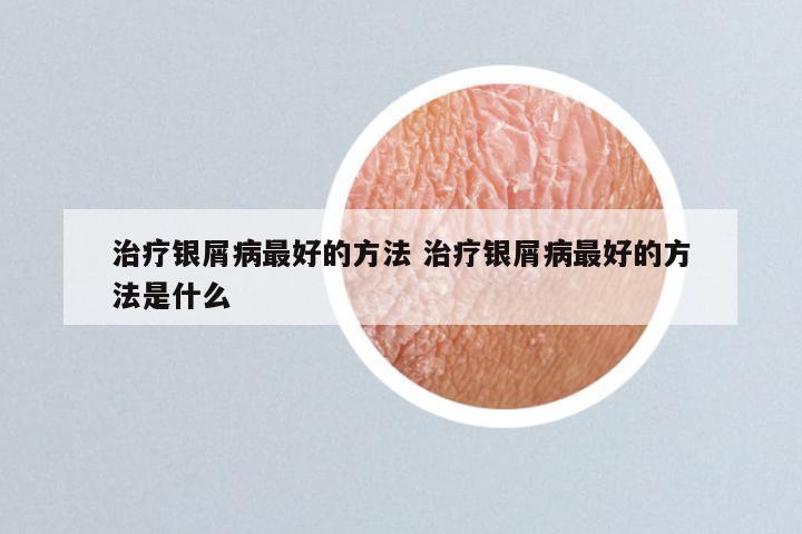 治疗银屑病最好的方法 治疗银屑病最好的方法是什么