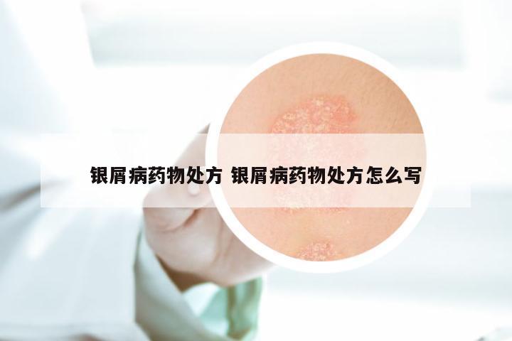 银屑病药物处方 银屑病药物处方怎么写