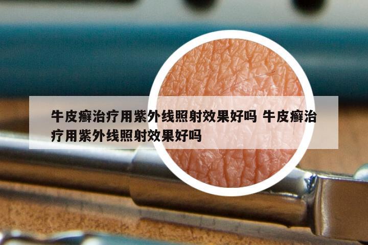牛皮癣治疗用紫外线照射效果好吗 牛皮癣治疗用紫外线照射效果好吗