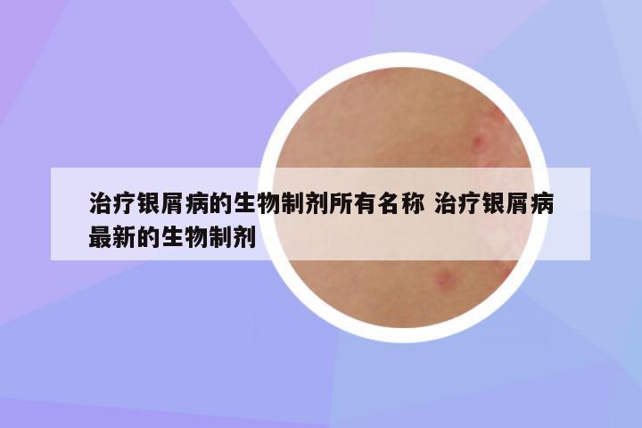 治疗银屑病的生物制剂所有名称 治疗银屑病最新的生物制剂