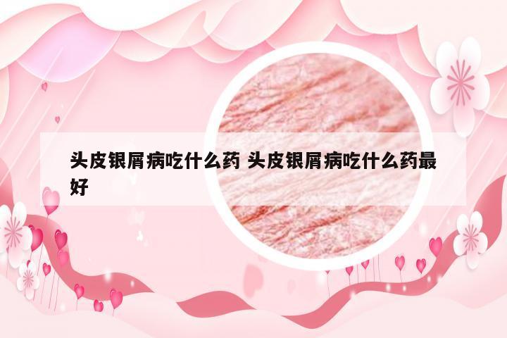头皮银屑病吃什么药 头皮银屑病吃什么药最好