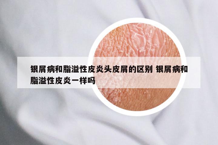 银屑病和脂溢性皮炎头皮屑的区别 银屑病和脂溢性皮炎一样吗