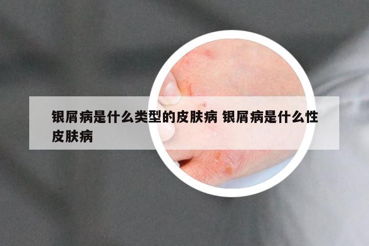 银屑病是什么类型的皮肤病 银屑病是什么性皮肤病