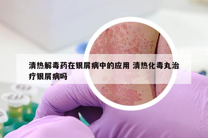 清热解毒药在银屑病中的应用 清热化毒丸治疗银屑病吗