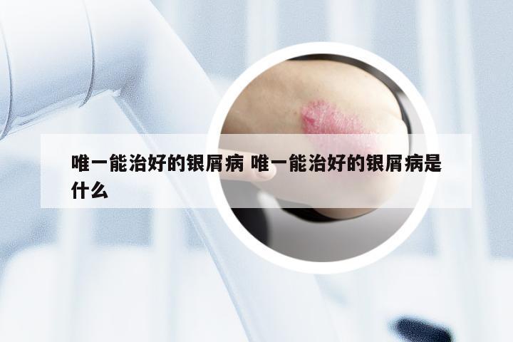 唯一能治好的银屑病 唯一能治好的银屑病是什么