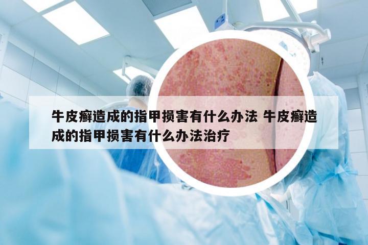 牛皮癣造成的指甲损害有什么办法 牛皮癣造成的指甲损害有什么办法治疗