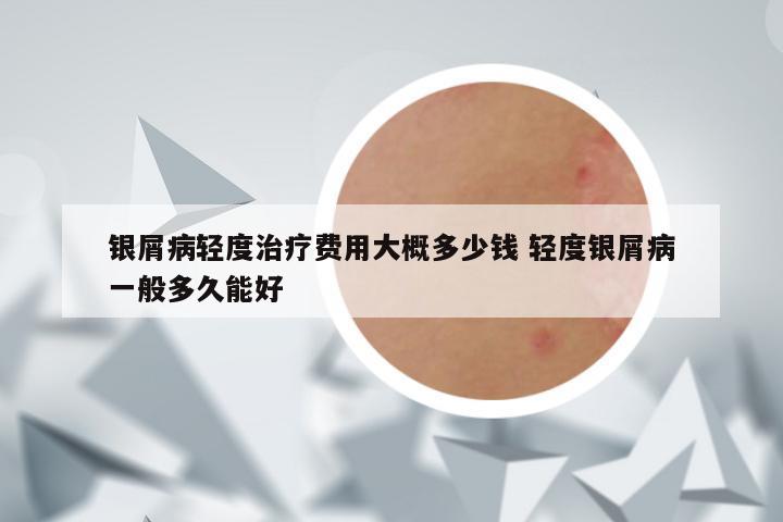银屑病轻度治疗费用大概多少钱 轻度银屑病一般多久能好
