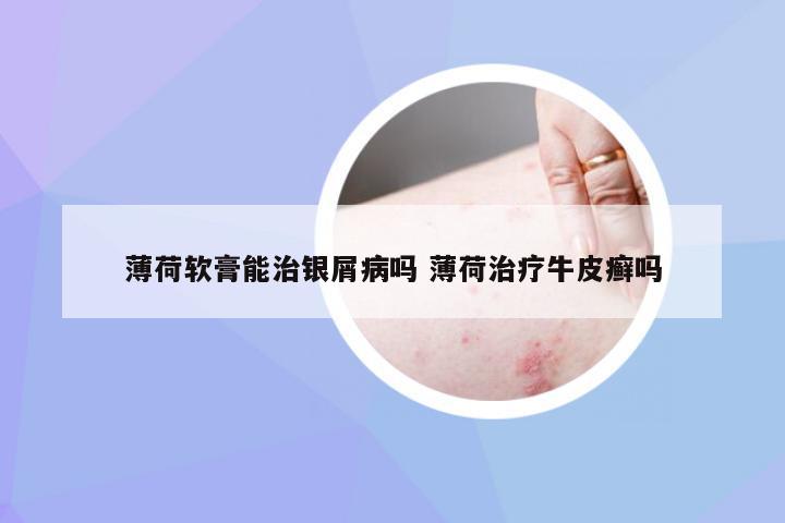 薄荷软膏能治银屑病吗 薄荷治疗牛皮癣吗
