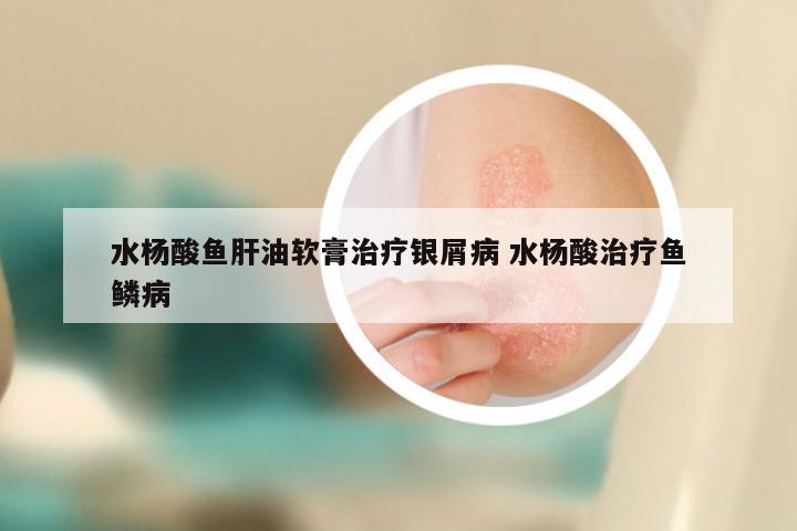水杨酸鱼肝油软膏治疗银屑病 水杨酸治疗鱼鳞病