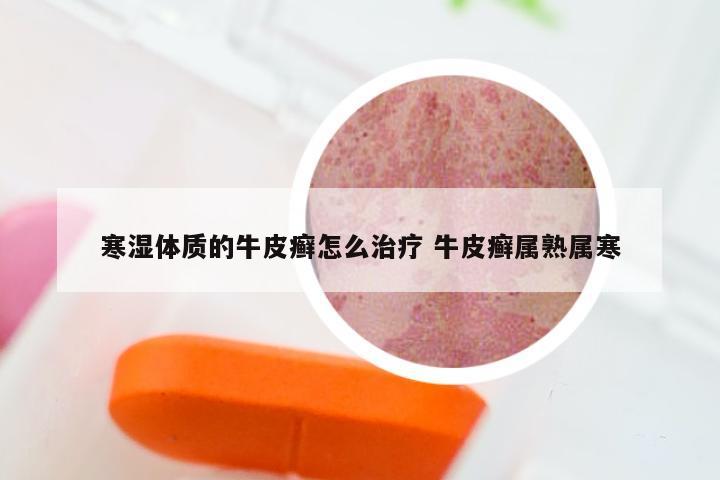 寒湿体质的牛皮癣怎么治疗 牛皮癣属熟属寒