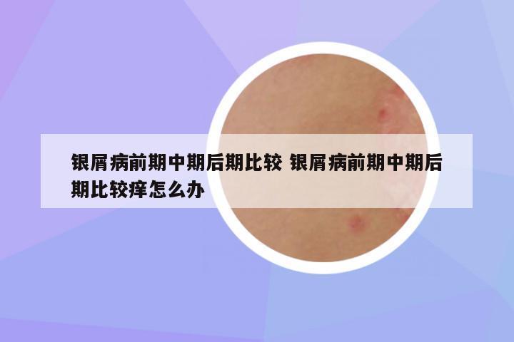 银屑病前期中期后期比较 银屑病前期中期后期比较痒怎么办