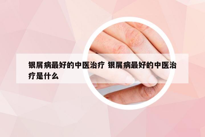 银屑病最好的中医治疗 银屑病最好的中医治疗是什么