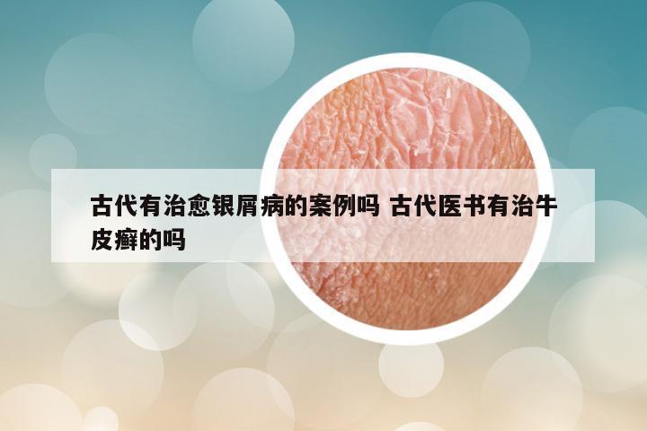 古代有治愈银屑病的案例吗 古代医书有治牛皮癣的吗