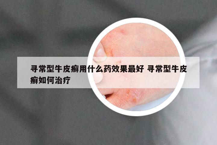 寻常型牛皮癣用什么药效果最好 寻常型牛皮癣如何治疗